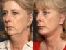 Brow Lift