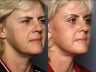 Brow Lift