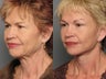 Brow Lift