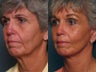 Brow Lift