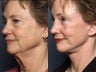Brow Lift