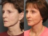 Brow lift