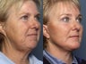 Brow Lift