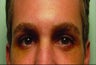 Endoscopic Brow lift