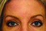 Brow lift with BOTOX