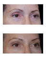 Lateral Brow Lift