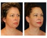 Facial Rejuvenation