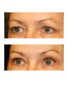 Brow lift