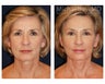 Facial Rejuvenation