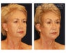 Facial Rejuvenation - Brow Lift