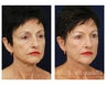 Facial Rejuvenation - Brow Lift