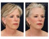 Facial Rejuvenation - Brow Lift