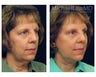 Facial Rejuvenation - Brow Lift