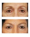 Facial Rejuvenation - Brow Lift