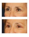 Facial Rejuvenation - Brow Lift