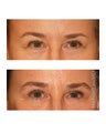 Facial Rejuvenation - Brow Lift