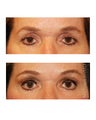 Facial Rejuvenation - Brow Lift