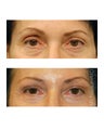Facial Rejuvenation - Brow Lift