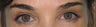 Lateral hood lift and blepharoplasty
