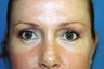 Browlift Procedure