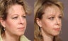 Brow Lift
