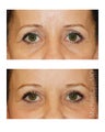Brow Lift