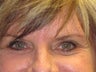 Brow Lift