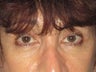 Brow Lift