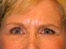 Brow Lift