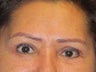 Brow Lift