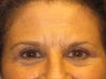 Brow Lift