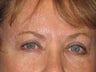 Brow Lift