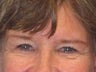 Brow Lift