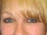 Brow Lift