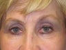 Brow Lift