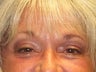Brow Lift