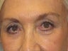 Brow Lift