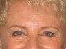 Brow Lift