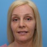 Brow Lift with Upper and Lower Blepharoplasty