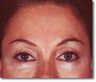 Brow Lift