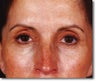 Brow Lift