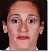 Brow Lift