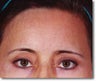 Brow Lift