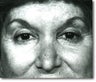 Brow Lift