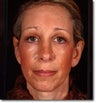 Brow Lift