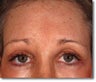 Brow Lift