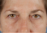 Browlift and Upper/Lower Eyes