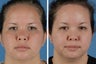 Endoscopic Brow Lift