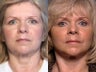 Brow Lift
