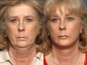 Brow Lift